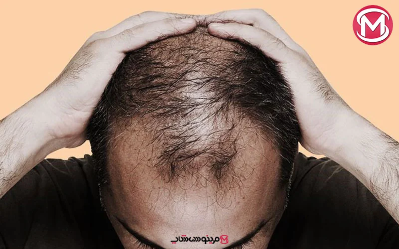 ریزش موی شدید در تمامی بدن: