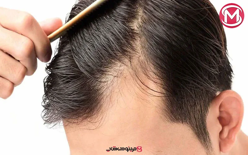 نازک شدن مو چیست؟