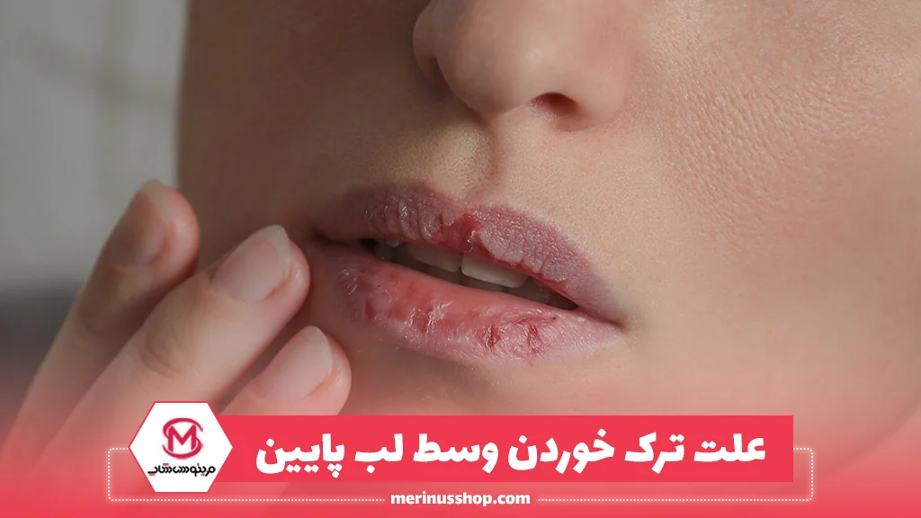 علت ترک خوردن وسط لب پایین